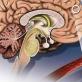 История болезни по неврологии Ишемический инсульт бассейне правой сма